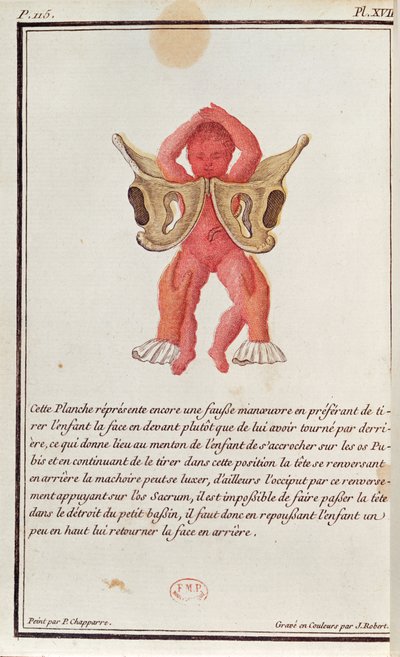 Cross-sectional Diagram of a Baby Pulled from the Womb by the Legs, from a Book by Madame Angelique Le Boursier du Coudray, 1783 by P. Chapparre